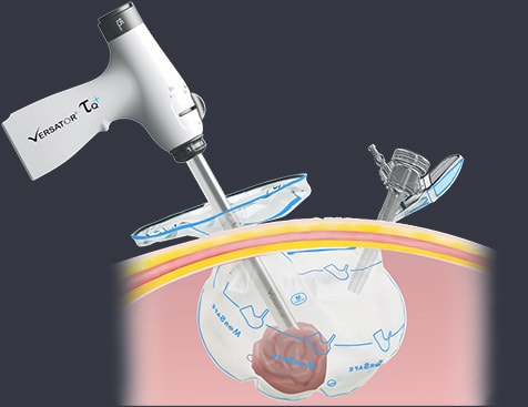 Surgical Workshop for Laparoscopic In-Bag Morcellation › A.M.I